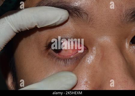 Hornhautinfektion oder Geschwulst genannt Keratitis bei asiatischen jungen Mann. Stockfoto