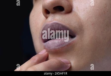 Zyanotische Lippen oder zentrale Zyanose bei einem jungen Mann aus Südostasien mit angeborenem Herzfehler. Stockfoto