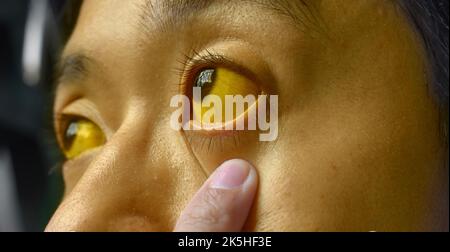 Tiefer Gelbsucht bei einem asiatischen männlichen Patienten. Gelbliche Verfärbung von Haut und Sklera. Hyperbilirubinämie. Akute Hepatitis. Stockfoto