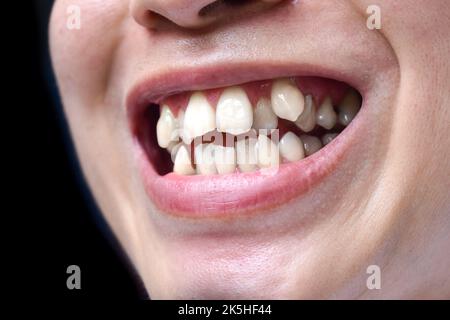 Gestapelte oder überlappende weiße Zähne des asiatischen Mannes. Auch gedrängte Zähne genannt. Stockfoto