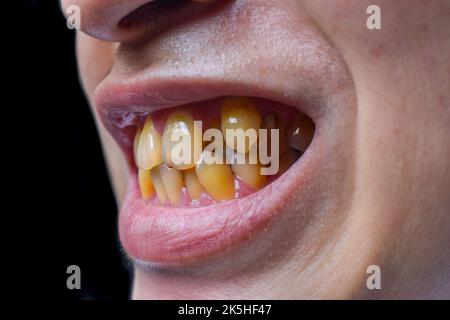 Überfüllte Zähne mit gelb gefärbten Tabakflecken. Schlechte Mundhygiene. Stockfoto