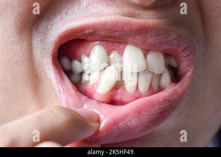 Gestapelte oder überlappende weiße Zähne des asiatischen Mannes. Auch gedrängte Zähne genannt. Stockfoto