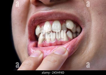 Gestapelte oder überlappende weiße Zähne des asiatischen Mannes. Auch gedrängte Zähne genannt. Stockfoto