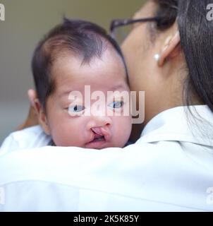 Eine Schulter zum Schreien. Ein kleines Mädchen, das eine Gaumenspalte hat und über die Schulter ihrer Mutter schaut. Stockfoto