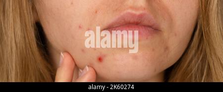 Nicht erkennbare Frau, die ihre Akne im Gesicht zeigt. Nahaufnahme Akne auf dem Gesicht der Frau mit Hautausschlag, Narbe und vor Ort, die allergisch auf Kosmetika. Banner Problem Hautpflege und Gesundheit Konzept. Falten, Melasma, dunkle Flecken, Sommersprossen, trockene Haut, Akne Mitesser auf Gesicht mittleren Alters Frauen Kinn Akne Problem. Pickel auf dem Bart. Problem Haut in einem jungen Mädchen. Hormonelle Fehlbalance. Hauterkrankungen führen bei Frauen zu Depressionen und Unsicherheiten Stockfoto