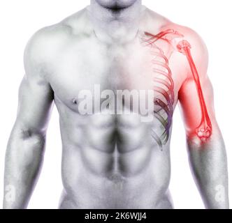 Fusionsbild von menschlichem und CT san Humerus 3D, das bei Fraktur des Schultergelenks auftritt. Stockfoto