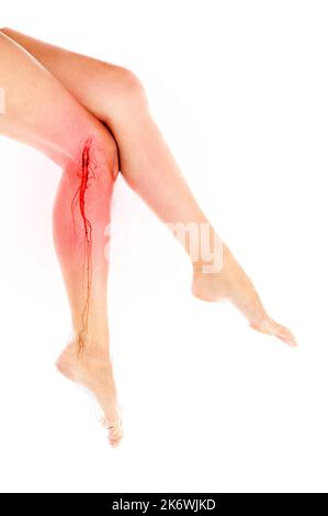 Krampfadern an den Beinen der Frau vom Bein mit CTA femorale Arterie 3D. Stockfoto