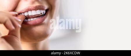 Eine Frau zieht einen unsichtbaren Zahnausrichter aus Silikon an. Zahnspangen für die Zahnkorrektur. Stockfoto