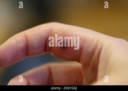 Hundebiss am Zeigefinger einer weißen Frau. Es kommt zu einer leichten Schwellung, Rötung, Blutergüssen, trockenem Blut und dem Beginn eines Schorfens. - Makromedizinische sie Stockfoto