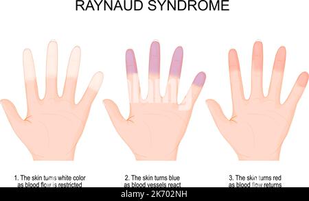 Raynaud-Syndrom. Hände einer Person mit Raynaud-Phänomen während eines Angriffs von weißer Farbe, wenn der Blutfluss auf blau und rot beschränkt ist Stock Vektor