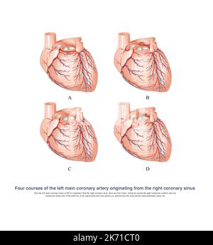 Die abnorme linke Koronarararterie entstand aus dem rechten Koronarsinus, der eine der Ursachen für den plötzlichen Tod ist. Stockfoto