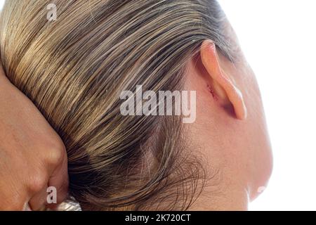 Schuppenflechte hinter dem Ohr. Psoriatische Rötung, Peeling und Krusten hinter dem Ohr einer nicht erkennbaren Frau. Autoimmune, unheilbare dermatologische Haut Stockfoto