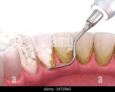 Mundhygiene: scaling und root Planing (konventionelle Parodontaltherapie). Medizinisch genaue 3D-Abbildung der menschlichen Zähne Behandlung Stockfoto