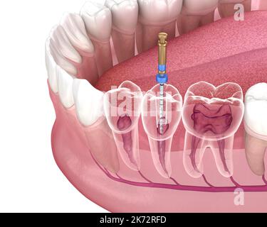 Endodontische Wurzelbehandlung. Medizinisch akkurate Zahn 3D Abbildung. Stockfoto