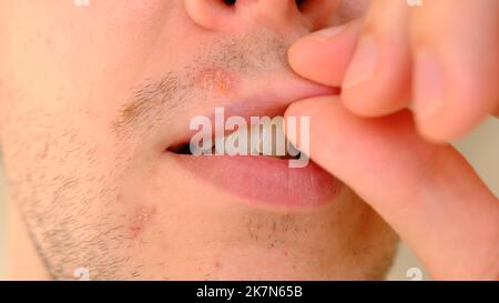 Mann mit Herpes auf Lippen vor hellgrauem Hintergrund. Kalte Wunden an den Lippen eines Mannes. Wunde Virus Konzept. Mann berührt schmerzhaft mit den Fingern. Stockfoto