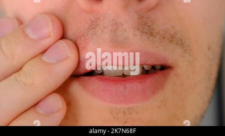 Mann mit Herpes auf Lippen vor hellgrauem Hintergrund. Kalte Wunden an den Lippen eines Mannes. Wunde Virus Konzept. Mann berührt schmerzhaft mit den Fingern. Stockfoto