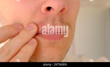 Mann mit Herpes auf Lippen vor hellgrauem Hintergrund. Kalte Wunden an den Lippen eines Mannes. Wunde Virus Konzept. Mann berührt schmerzhaft mit den Fingern. Stockfoto