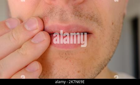 Mann mit Herpes auf Lippen vor hellgrauem Hintergrund. Kalte Wunden an den Lippen eines Mannes. Wunde Virus Konzept. Mann berührt schmerzhaft mit den Fingern. Stockfoto