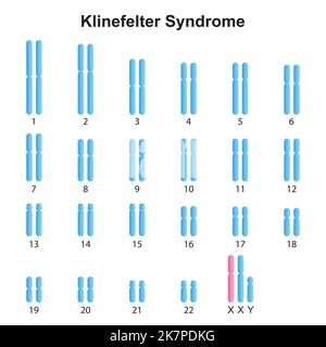 Wissenschaftliche Entwicklung des Klinefelter-Syndroms (XXY) Karyotyps. Bunte Symbole. Vektorgrafik. Stock Vektor