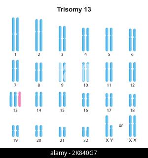 Wissenschaftliche Entwicklung des Patau-Syndroms (Trisomie 13) Karyotyps. Bunte Symbole. Vektorgrafik. Stock Vektor