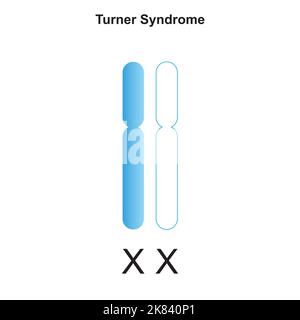Wissenschaftliche Entwicklung des Turner-Syndroms (Monosomie X). Bunte Symbole. Vektorgrafik. Stock Vektor