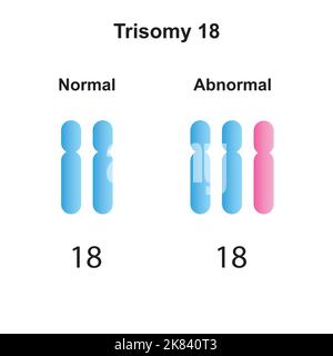 Wissenschaftliche Entwicklung des Edwards-Syndroms (Trisomie 18). Bunte Symbole. Vektorgrafik. Stock Vektor