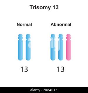 Wissenschaftliche Entwicklung des Patau-Syndroms (Trisomie 13). Bunte Symbole. Vektorgrafik. Stock Vektor