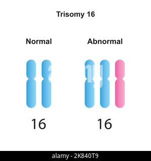 Wissenschaftliche Gestaltung der Mosaischen Trisomie 18 Karyotyp. Bunte Symbole. Vektorgrafik. Stock Vektor