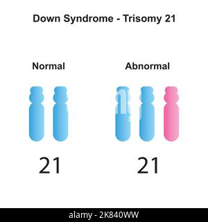 Wissenschaftliche Entwicklung des Down-Syndroms (Trisomie 21). Bunte Symbole. Vektorgrafik. Stock Vektor