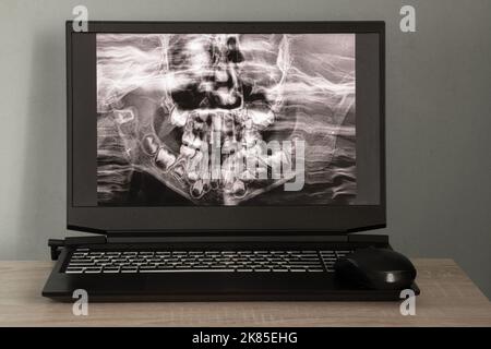 Panorama-Röntgenaufnahme der Kinderzähne von zwei Kiefers, Orthopantomogramm der Kinderzähne auf Laptop-Bildschirmen auf dem Tisch Stockfoto