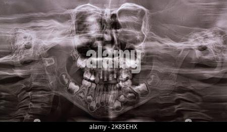 Ein Panorama-Röntgenbild zeigt mehrere eingebettete und betroffene Zähne sowohl am Ober- als auch am Unterkiefer der Kinderzähne Stockfoto