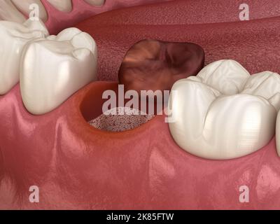 Alveolits - nach der Zahnextraktion geöffnete trockene Seide. Medizinisch genaue 3D-Darstellung Stockfoto