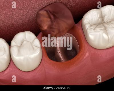 Alveolits - nach der Zahnextraktion geöffnete trockene Seide. Medizinisch genaue 3D-Darstellung Stockfoto