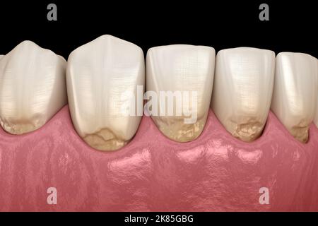 Abfraktion der vorderen Zähne. Medizinisch genaue 3D-Darstellung Stockfoto