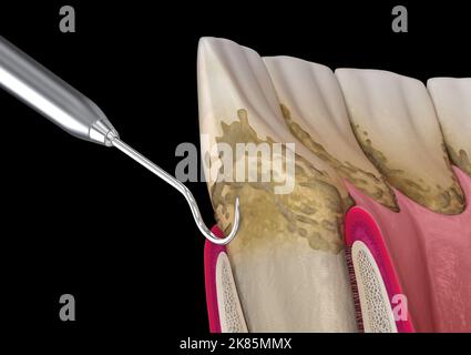 Mundhygiene: scaling und root Planing (konventionelle Parodontaltherapie). Medizinisch genaue 3D-Abbildung der menschlichen Zähne Behandlung Stockfoto