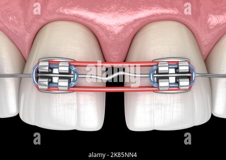 Gummibänder und Metallspangen für die Diastema-Korrektur. Medizinisch genaue zahnärztliche 3D Illustration Stockfoto