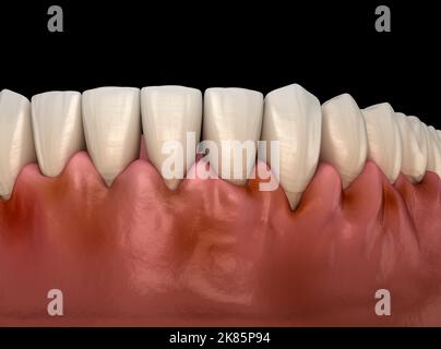 Gingivitis Entzündung des Zahnfleisches. Medizinisch genaue 3D-Darstellung Stockfoto