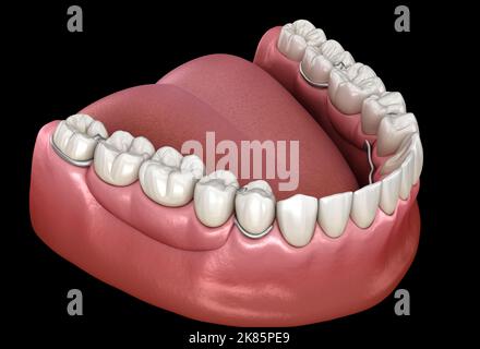 Herausnehmbare Teilprothese, Unterkieferprothese. Medizinisch akkurate 3D Illustration des Prothetikkonzepts Stockfoto