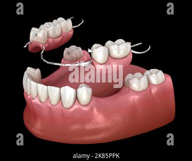 Herausnehmbare Teilprothese, Unterkieferprothese. Medizinisch akkurate 3D Illustration des Prothetikkonzepts Stockfoto