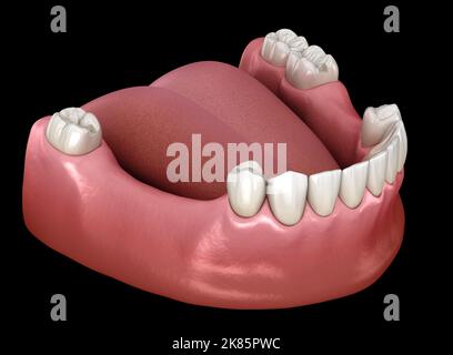 Herausnehmbare Teilprothese, Unterkieferprothese. Medizinisch akkurate 3D Illustration des Prothetikkonzepts Stockfoto