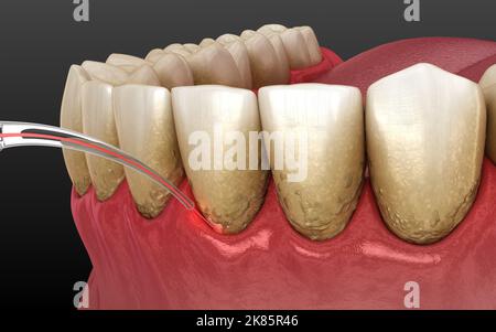 Laser entfernt Zahnstein und dünne Schicht der infizierten Haut, Zahnreinigung. Medizinisch akkurate Zahn 3D Abbildung Stockfoto