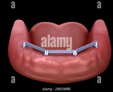 Herausnehmbare Unterkieferprothese mit Zahnfleisch All ON 4 System, unterstützt durch Implantate. Medizinisch akkurate 3D Darstellung von menschlichen Zähnen und Prothesen Stockfoto