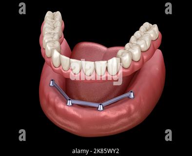 Herausnehmbare Unterkieferprothese mit Zahnfleisch All ON 4 System, unterstützt durch Implantate. Medizinisch akkurate 3D Darstellung von menschlichen Zähnen und Prothesen Stockfoto