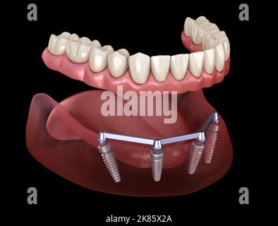Herausnehmbare Unterkieferprothese mit Zahnfleisch All ON 4 System, unterstützt durch Implantate. Medizinisch akkurate 3D Darstellung von menschlichen Zähnen und Prothesen Stockfoto