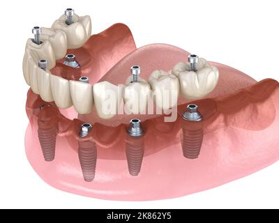 Unterkieferprothese All on 4 System unterstützt durch Implantate, Schraubfixierung. Medizinisch akkurate 3D Illustration des Zahnkonzepts Stockfoto