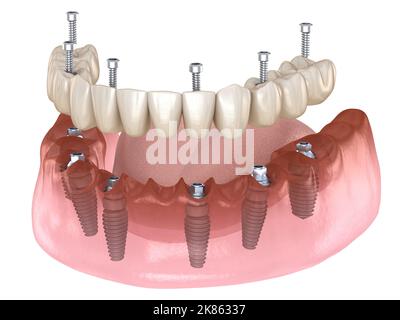 Unterkieferprothese All on 4 System unterstützt durch Implantate, Schraubfixierung. Medizinisch akkurate 3D Illustration des Zahnkonzepts Stockfoto