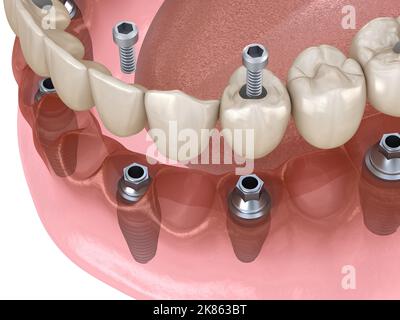 Unterkieferprothese All on 4 System unterstützt durch Implantate, Schraubfixierung. Medizinisch akkurate 3D Illustration des Zahnkonzepts Stockfoto