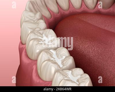 Molare Fissur Zahnfüllungen, medizinisch genaue 3D Illustration des Zahnkonzepts Stockfoto