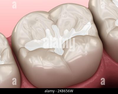 Molare Fissur Zahnfüllungen, medizinisch genaue 3D Illustration des Zahnkonzepts Stockfoto