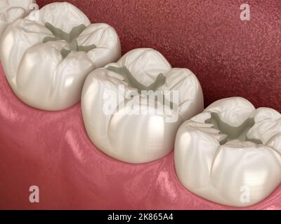 Präparierte Molar-Fissur für Füllungen Platzierung, medizinisch genaue 3D Illustration des Zahnkonzepts Stockfoto